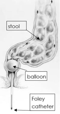 Stool diagram