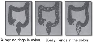 Colon
