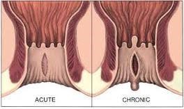 Acute vs chronic