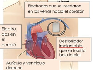 ICD heart