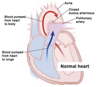 PDA heart