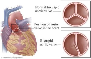heart valve