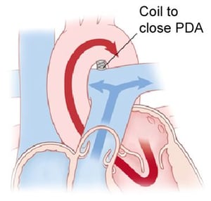 coil PDA