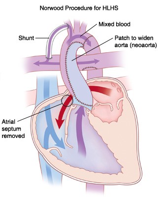 norwood procedure diagram