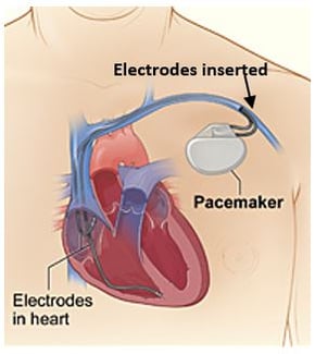pacemaker