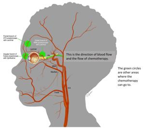 Intra-arterial chemotherapy for Retinoblastoma Diagram