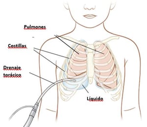 chest tube
