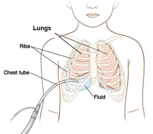 chest-tube