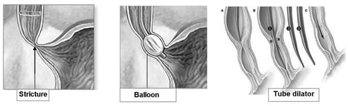 stricture