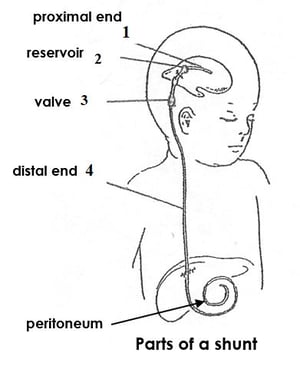 shunt