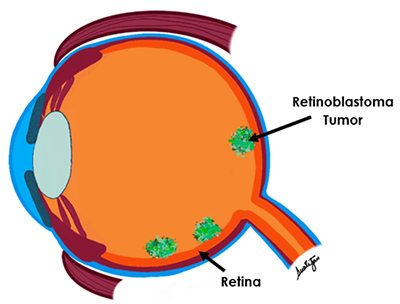 retinoblastoma