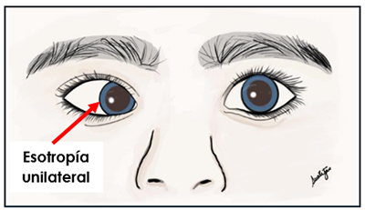 esotropía unilateral