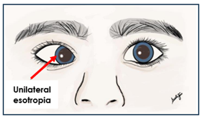 unilateral esotropia