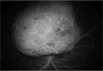 Fluorescein Angiography