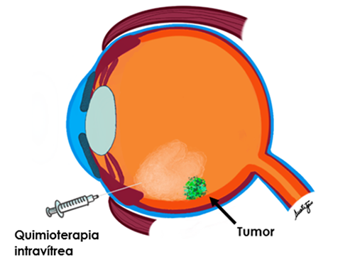 2235 Intra-vitreal chemotherapy SP