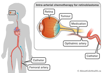 Intra-arterial chemotherapy
