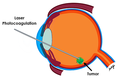 Laser Photocoagulation
