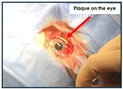 Plaque on Eye