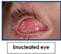 enucleation