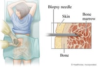 Bone marrow aspiration