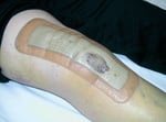 bandage on knee