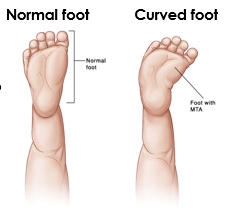Normal or Curved Foot