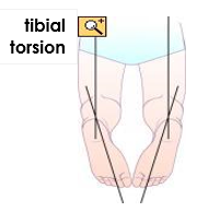 Tibial torsion