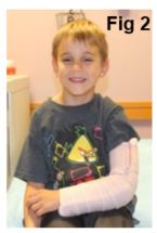 child in splint