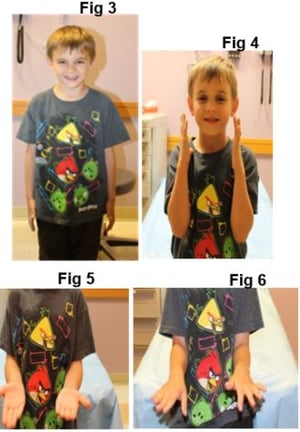 splint steps