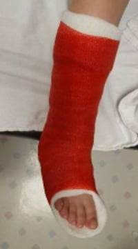 leg in cast