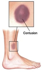 bruise on foot