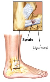 foot sprain