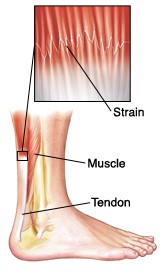 ankle sprain