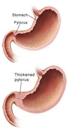 What is pyloric stenosis