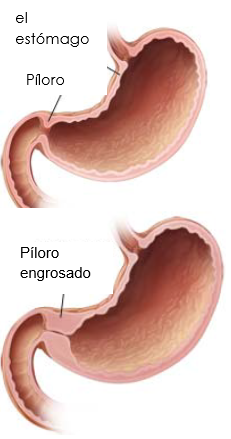 What is pyloric stenosis