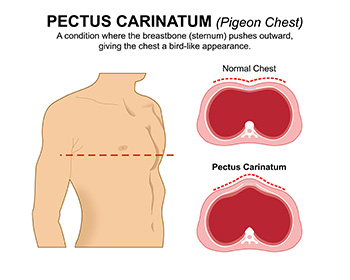 1958 - Pectus Carniatum