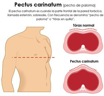 Pectus Carniatum