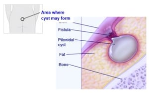 cysts