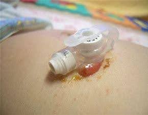 Close up of feeding tube on patient