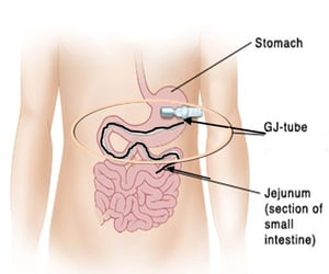 GJ tube