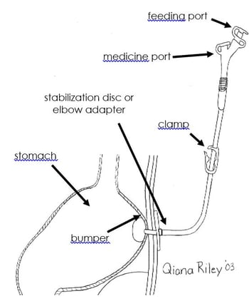peg tube