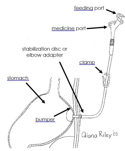 peg tube