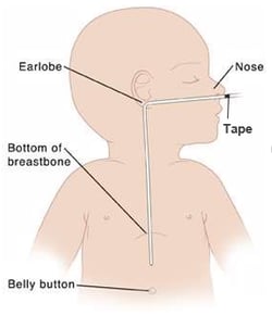 baby with feeding tube