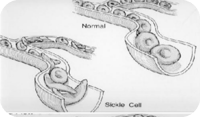 Sickle cell and normal cell