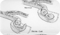 Sickle cell and normal cell