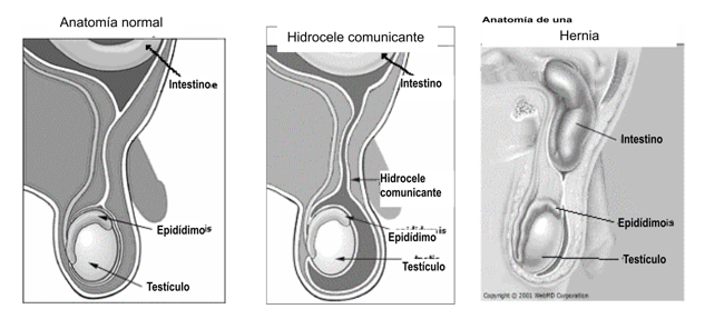 Hernia Diagrams