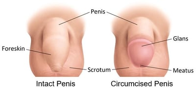circumcision