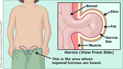 hernia