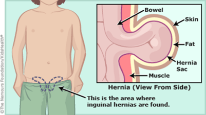 hernia