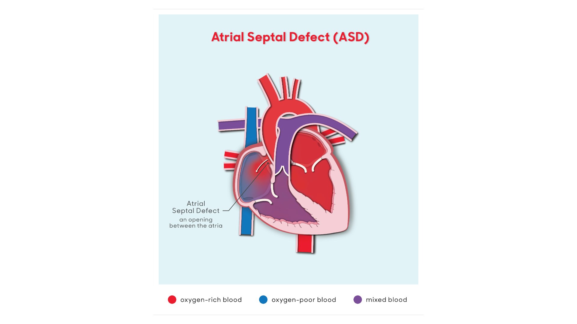 asd